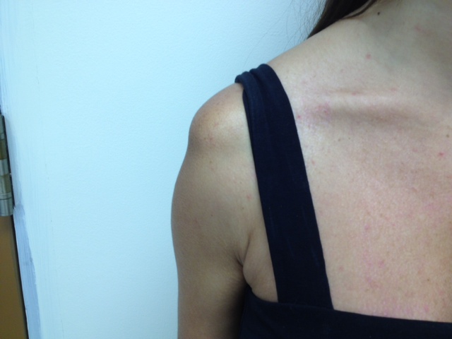 MDI Shoulder